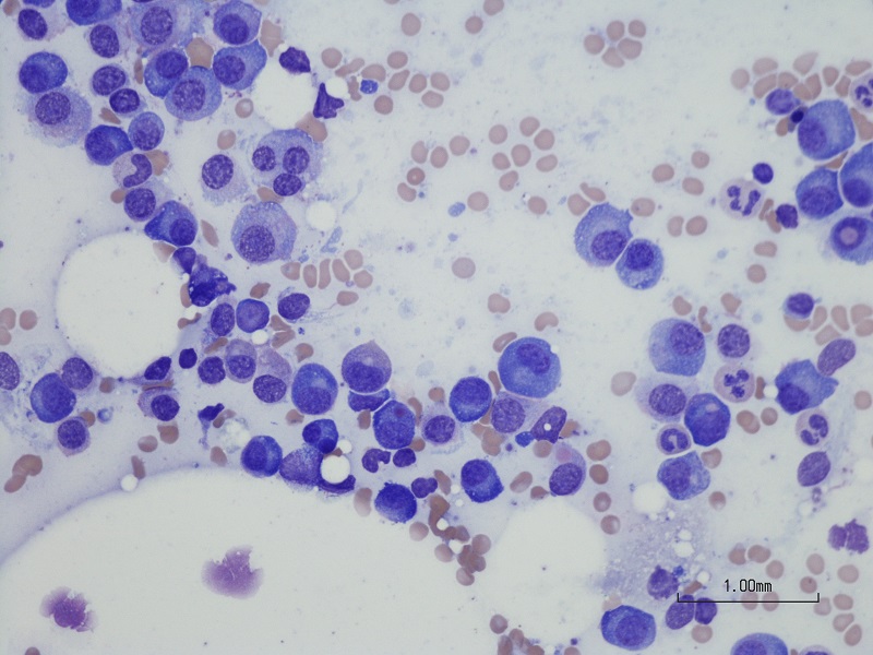 Plasma-Cell-Myeloma-Microscope_small